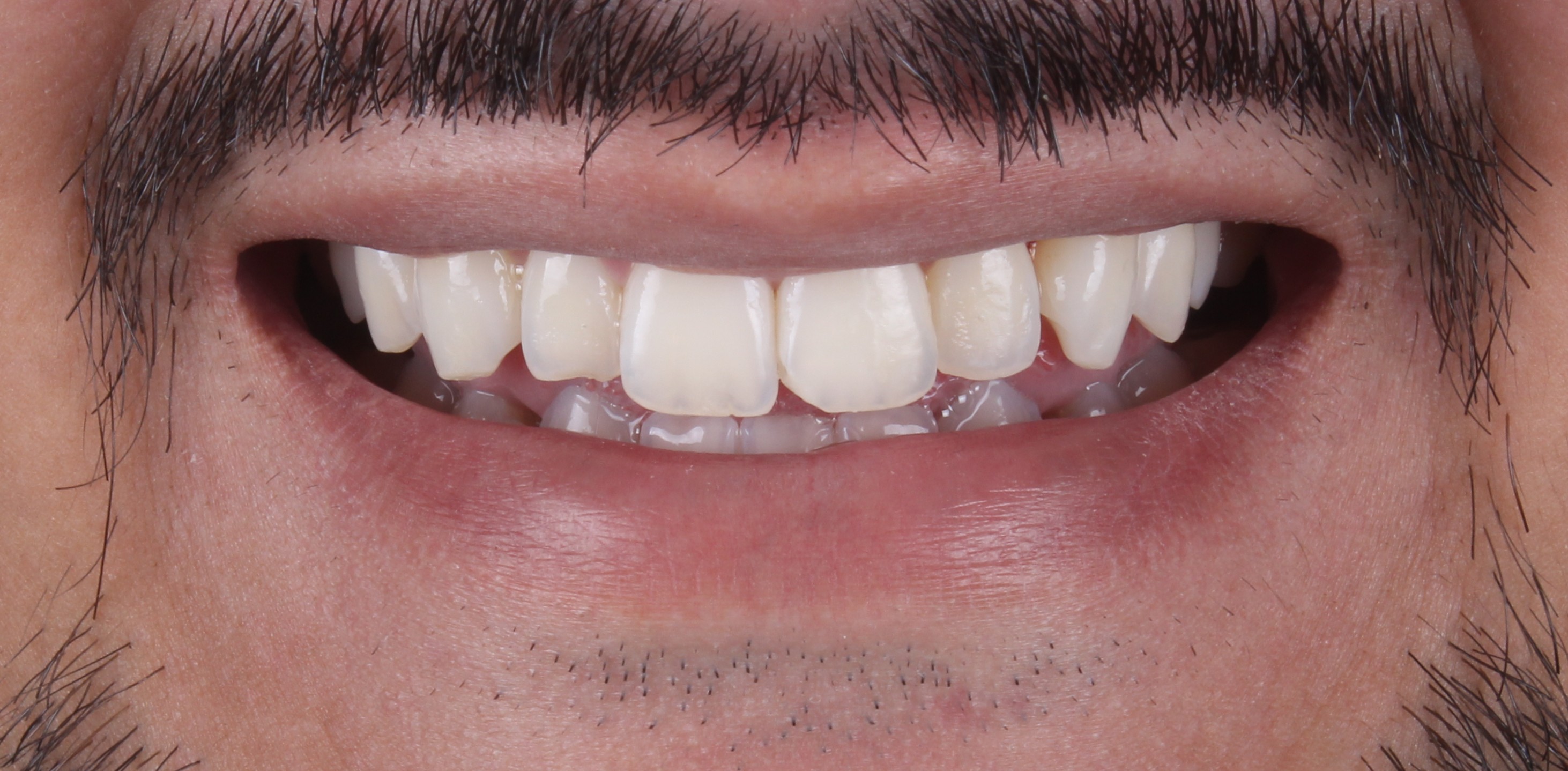 Depois do clareamento dental